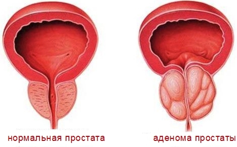 Лечебная физкультура (ЛФК) при простатите и аденоме простаты у мужчин